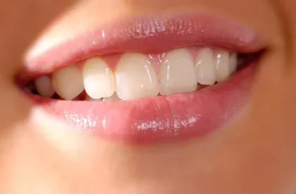 Improving Smiles
