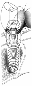 Dental implant detail