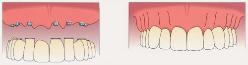 Dental implants supporting a complete prosthesis