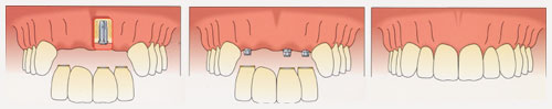 Front View Partial Prostheses