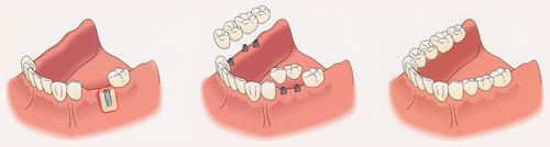 Partial Prosthesis Examples
