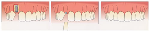 Single Prosthesis Dental Implants