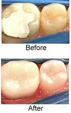 CEREC crowns