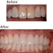 Before After