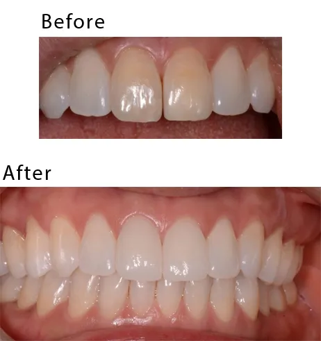 Before After