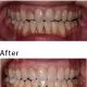 Before and after