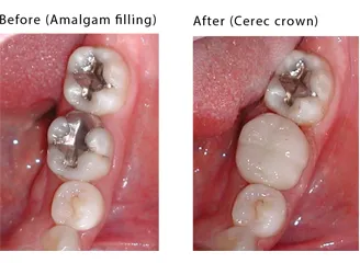 Before and after