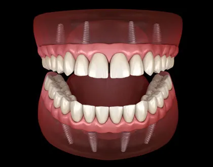 All-About-Dental-Implants