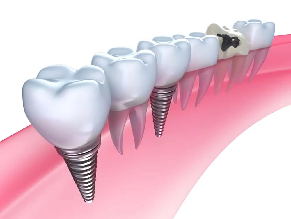 Are-Dental-Implants-the-Right-Choice-for-You