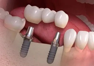 multiple-teeth-implants-dentist-specialist-midtown-nyc-300x210