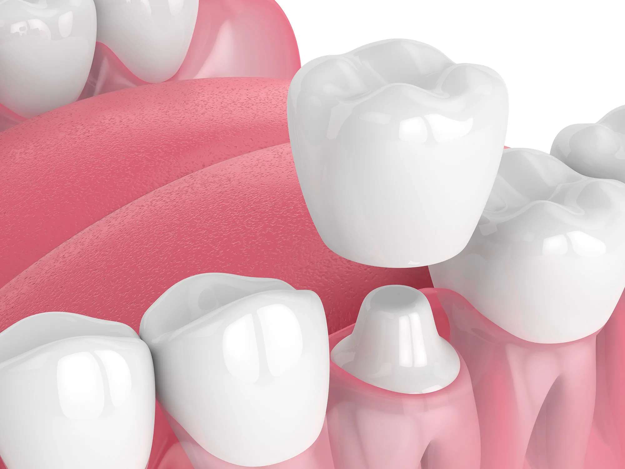 CEREC-Dental-Crowns