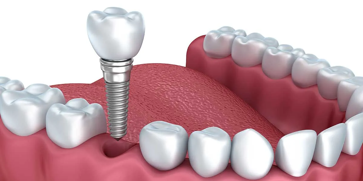 dental-implants-worth