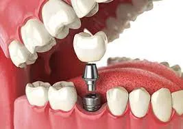 The-Benefits-of-Dental-implants