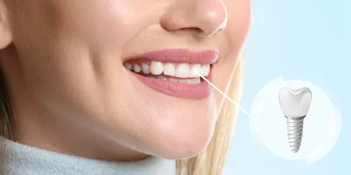 Dental Implants