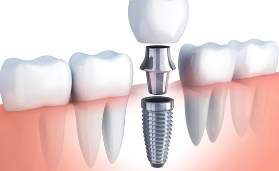 The Benefits of Dental Implants